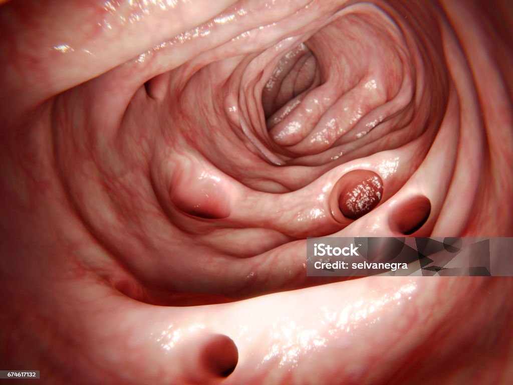 Diverticula in the colon The disease  diverticulitis results of the inflammation of one of these diverticula. The most common sympton is abdominal pain. Colonoscopy Stock Photo