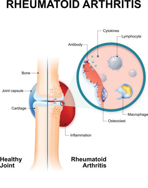 Rheumatoid Arthritis (RA) is an auto immune disease normal joint and one with rheumatoid arthritis. Rheumatoid Arthritis (RA) is an inflammatory type of arthritis that usually affects knees. the auto immune disease. The body's immune system mistakenly attacks healthy tissue. rheumatoid arthritis stock illustrations