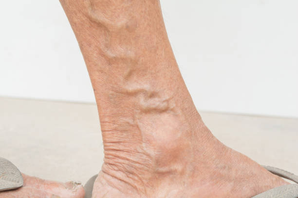 istock Varicose veins in old women 674888462