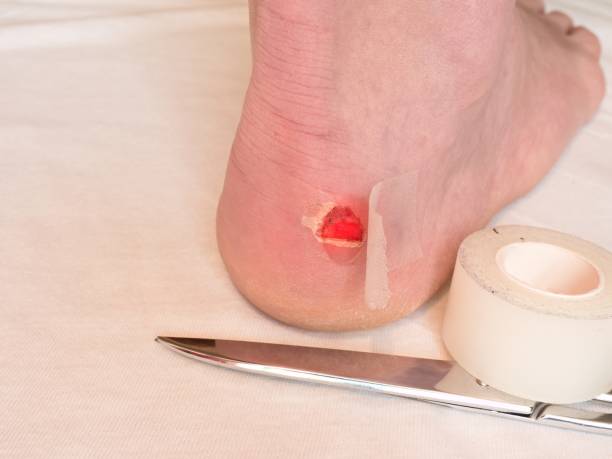 istock Heel wound with bandage, scissors ready. Craced terrible blister on human heel. 675219906