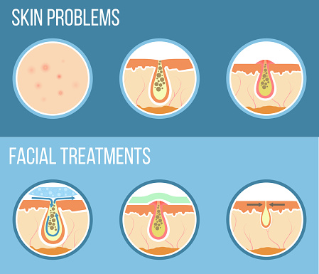 Skin problems such as acne, pimples and clogged pores. Facial treatment infographic, skin problems solution and skin care. Vector.