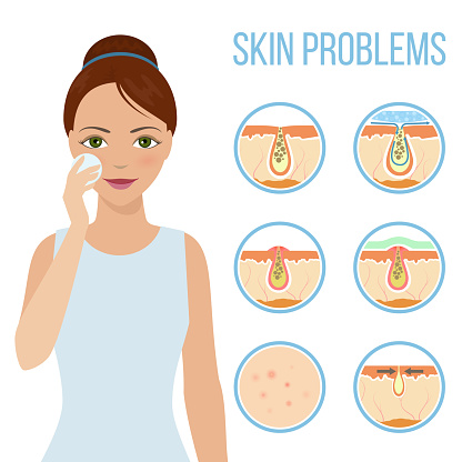 Girl cleans her face with cosmetic lotion. Skin problems such as acne, pimples and clogged pores. Facial treatment infographic, skin problems solution and skin care. Vector.