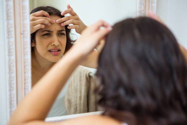 istock Woman popping her pimple 675445406