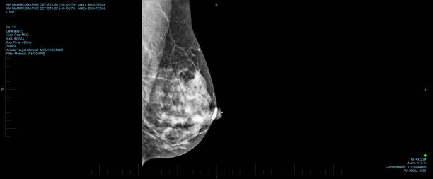 Mammogram screening for breast cancer stock photo