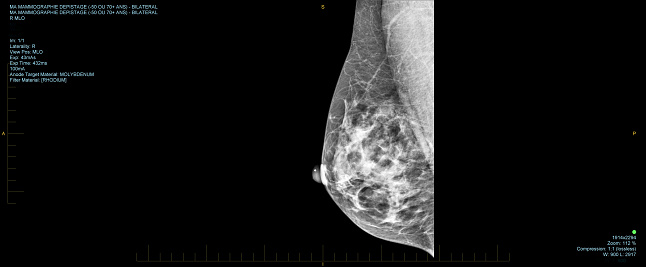 X-ray pictures or images of a woman's healthy breasts with no sign of breast cancer.