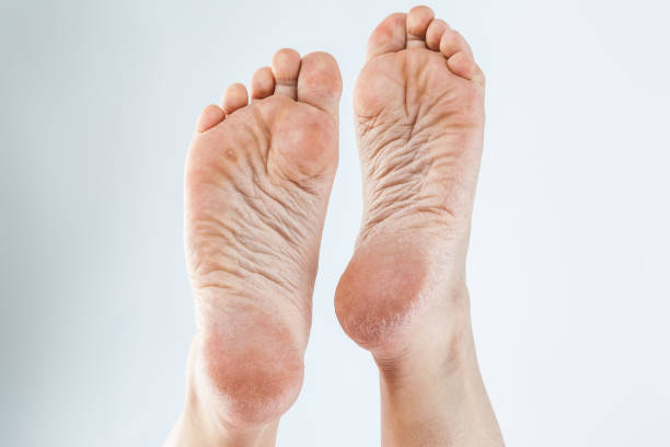 istock dehydrated skin female heels 675938248