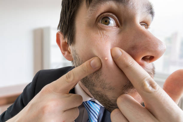 istock Young man is squeezing pimple or acne on his skin. 677494908