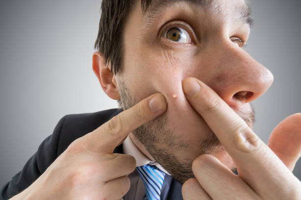 istock Young man is squeezing pimple or acne on his skin. 677501766