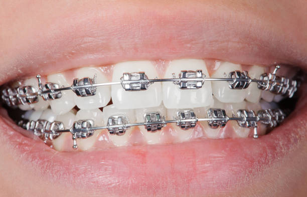 istock Close-up dental braces on teeth. Orthodontic Treatment 677502068