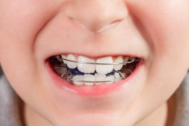 Child with orthodontic appliance close-up Child with orthodontic appliance close-up defection stock pictures, royalty-free photos & images