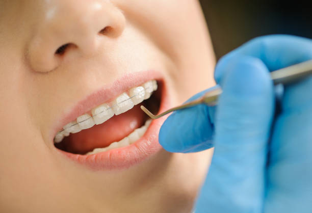 istock Woman with ceramic braces on teeth at the dental office 677581808