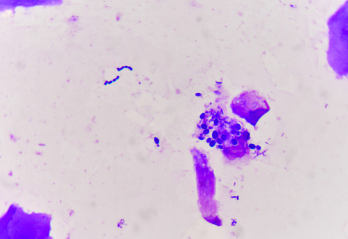 Yeast cells with epithelial tissue in Gram stain method.