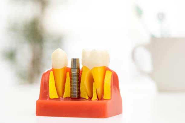 istock Set of Dentist's equipment tools, denture showing implant 678355874
