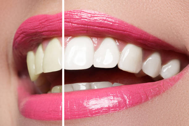 istock Woman teeth before and after whitening 678507372