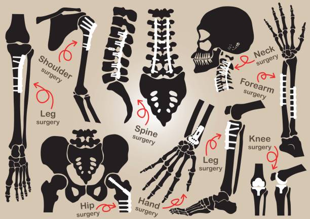 Collection of Orthopedic surgery ( Internal fixation by plate and screw )( skull , head , neck , spine , sacrum , arm , forearm , hand , elbow ,shoulder , pelvic , thigh , hip , knee , leg , foot ) Collection of Orthopedic surgery ( Internal fixation by plate and screw )( skull , head , neck , spine , sacrum , arm , forearm , hand , elbow ,shoulder , pelvic , thigh , hip , knee , leg , foot ) hip joint x stock illustrations