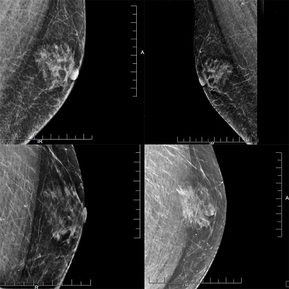 A Series of Four Mammogram images Showing a Male Patient's Gynecomastia (Benign Tumor).