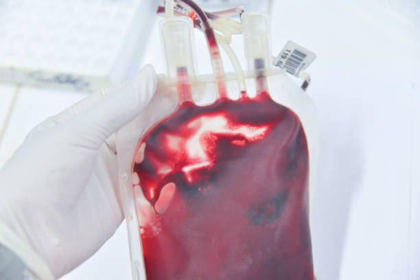 blood in the blood bag for the patient - blood bank imagens e fotografias de stock