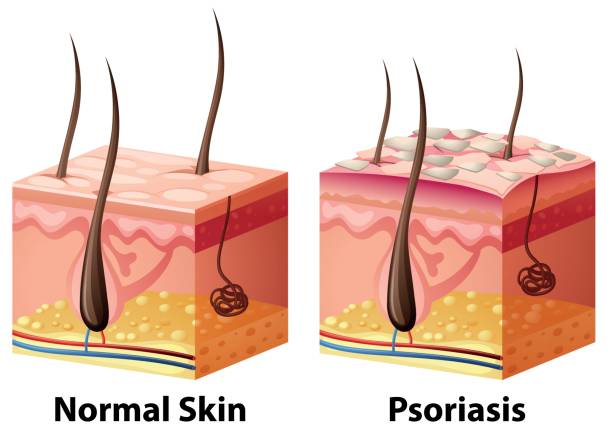 illustrations, cliparts, dessins animés et icônes de diagramme de la peau humaine normale et psoriasis - psoriasis