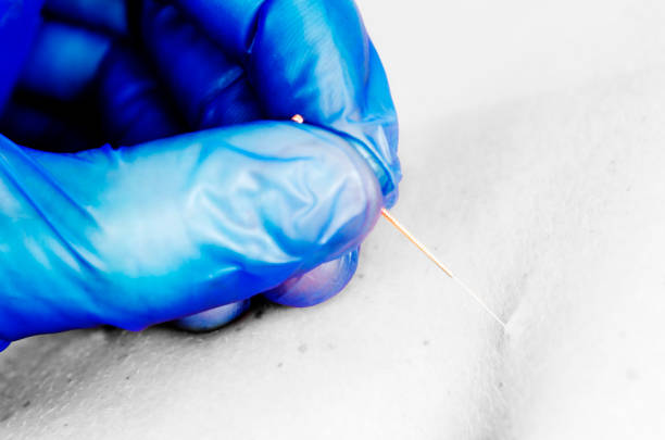 istock Needle and hands of physiotherapist doing a dry needling in silhouette studio on white background 679817810