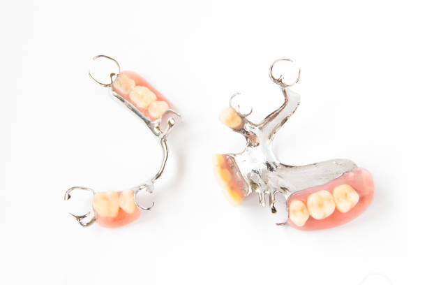 removable partial denture on white background. - dentures imagens e fotografias de stock