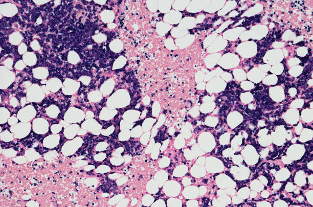 Micrograph of myeloma neoplasm from bone marrow biopsy stock photo