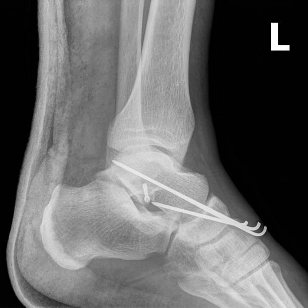 X-ray elements connecting the damaged ankle joint. X-ray elements from surgical stainless steel which secured ankle joint dislocation. roentgen stock pictures, royalty-free photos & images