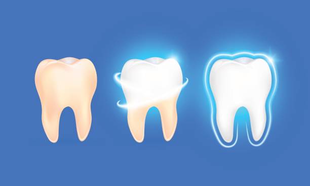 illustrazioni stock, clip art, cartoni animati e icone di tendenza di set di dente pulito e sporco su sfondo blu, processo di pulizia dei denti. - sbiancamento dentale
