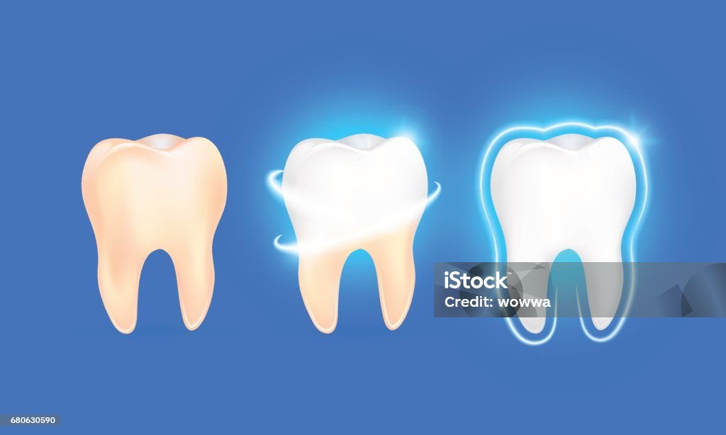 Set van schone en vuile tand op blauwe achtergrond, clearing tand proces. - Royalty-free Wit vectorkunst