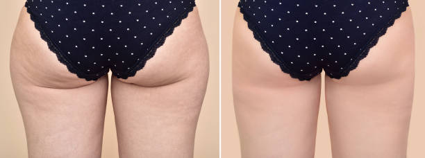 Woman before and after medical treatment Buttocks of an overweight woman with cellulite before and after medical treatment fat nutrient photos stock pictures, royalty-free photos & images