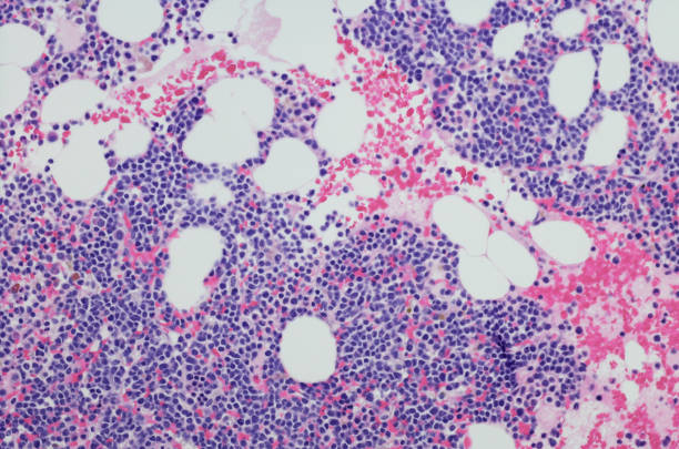 골수생검에서 골수종 신생물의 현미경 사진 - scientific micrograph 뉴스 사진 이미지