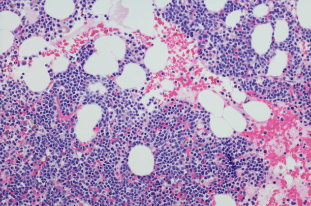 Micrograph of myeloma neoplasm from bone marrow biopsy Micrograph of myeloma neoplasm bone marrow biopsy. Hematoxylin and eosin staining (H&E) blood cell photos stock pictures, royalty-free photos & images