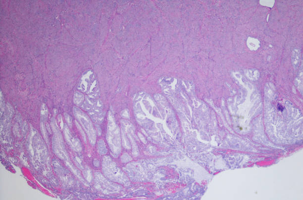 adenocarcinoma endometrial, tipo endometroid. h & e - endometrial adenocarcinoma - fotografias e filmes do acervo