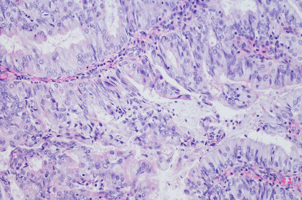 adenocarcinoma endometrial, tipo endometroid. h & e - endometrial adenocarcinoma - fotografias e filmes do acervo