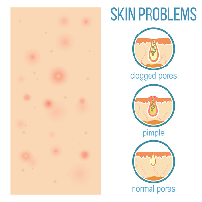 Skin problems such as acne, pimples and clogged pores. Top view of skin and side view of pores. Vector.