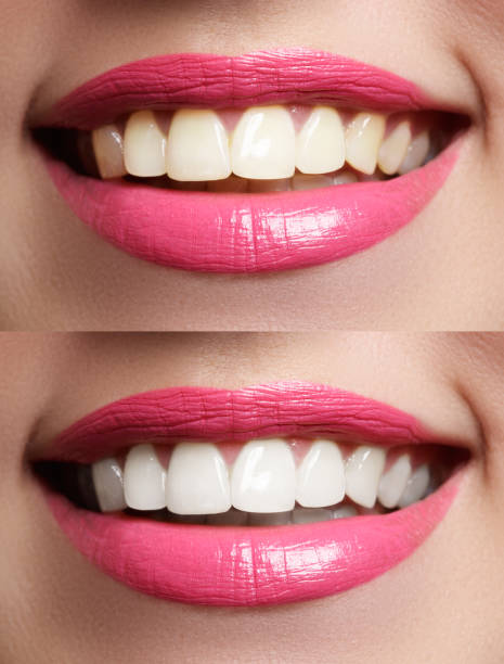 istock Woman teeth before and after whitening 681800648