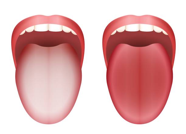 흰색 배경에 비교 고립 된 벡터 일러스트 레이 션에 의해 흰색 혀와 깨끗 한 건강 한 혀를 코팅. - mucosa stock illustrations