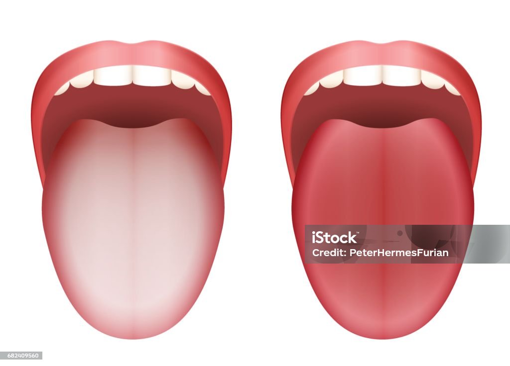 Coated white tongue and clean healthy tongue by comparison - isolated vector illustration on white background. Tongue stock vector