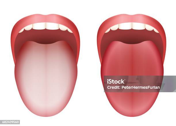 Coated White Tongue And Clean Healthy Tongue By Comparison Isolated Vector Illustration On White Background Stock Illustration - Download Image Now