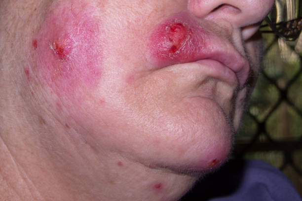 Mature woman with staph infection on face 8 Mature woman with staph infection on face 8, near Kuranda on the Atheron Tableland in Tropical North Queensland, Australia staphylococcal enterotoxicosis stock pictures, royalty-free photos & images