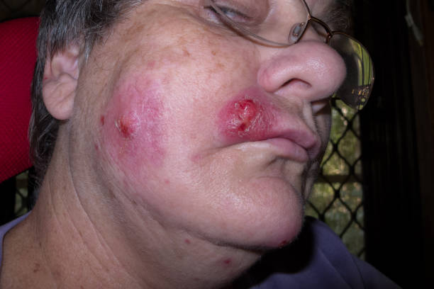 Mature woman with staph infection on face 5 Mature woman with staph infection on face 5, near Kuranda on the Atheron Tableland in Tropical North Queensland, Australia staphylococcal enterotoxicosis stock pictures, royalty-free photos & images
