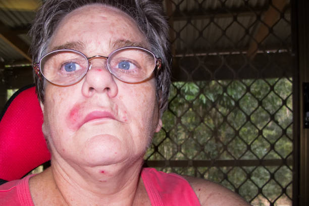 Mature woman with staph infection on face 2 Mature woman with staph infection on face 2, near Kuranda on the Atheron Tableland in Tropical North Queensland, Australia staphylococcal enterotoxicosis stock pictures, royalty-free photos & images