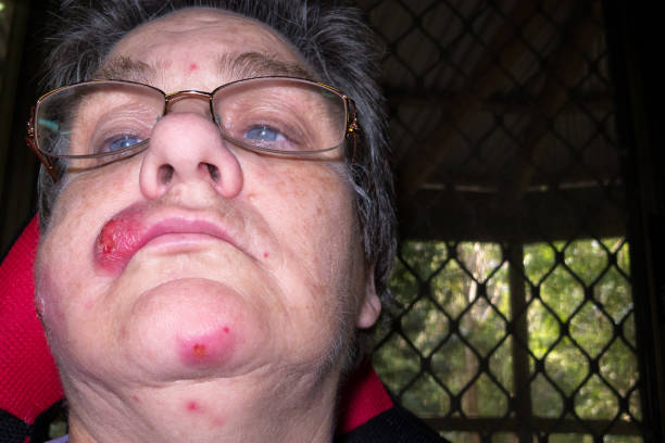 Mature woman with staph infection on face 7 Mature woman with staph infection on face 7, near Kuranda on the Atheron Tableland in Tropical North Queensland, Australia staphylococcal enterotoxicosis stock pictures, royalty-free photos & images