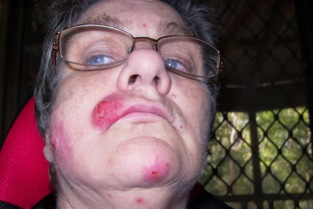 Mature woman with staph infection on face 6 Mature woman with staph infection on face 6, near Kuranda on the Atheron Tableland in Tropical North Queensland, Australia staphylococcal enterotoxicosis stock pictures, royalty-free photos & images