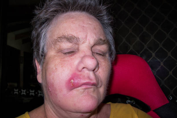 Mature woman with staph infection on face 3 Mature woman with staph infection on face 3, near Kuranda on the Atheron Tableland in Tropical North Queensland, Australia staphylococcal enterotoxicosis stock pictures, royalty-free photos & images