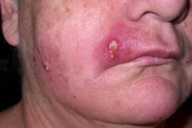 Mature woman with staph infection on face 4 Mature woman with staph infection on face 4, near Kuranda on the Atheron Tableland in Tropical North Queensland, Australia staphylococcal enterotoxicosis stock pictures, royalty-free photos & images