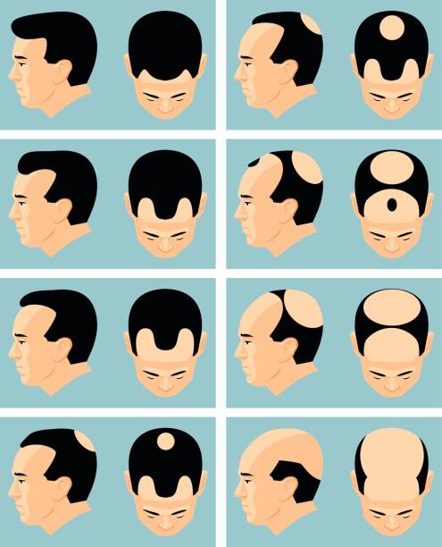 ilustrações, clipart, desenhos animados e ícones de bald - alopecia homem