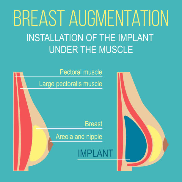 chirurgia piersi plastyczna ilustracja wektorowa - gland lobule stock illustrations