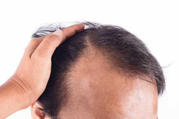 istock Bald head of young man o white background 683201240