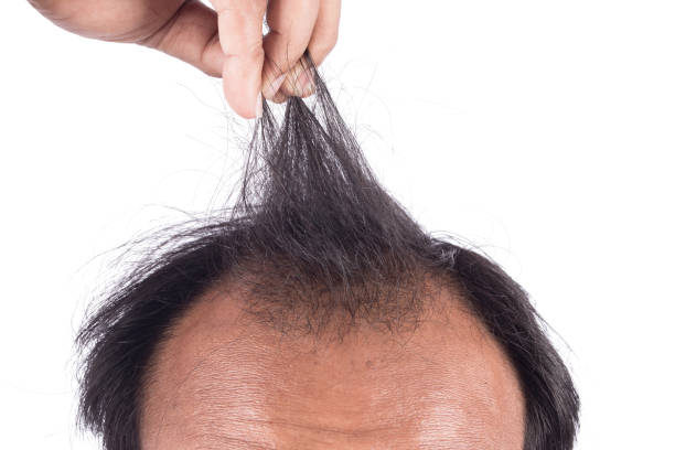 istock bald head of young man on white background 683201256