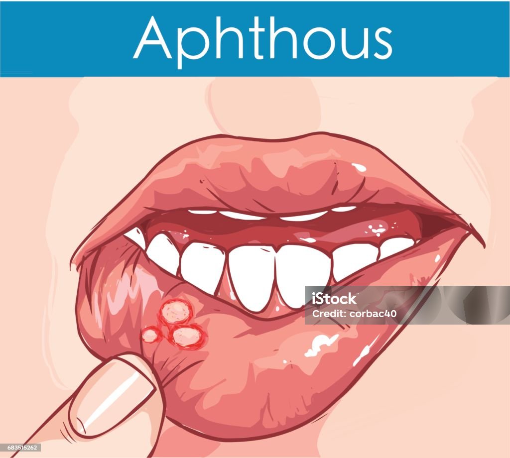 vector illustration of a Woman with aphthae on lip. Human Lips stock vector